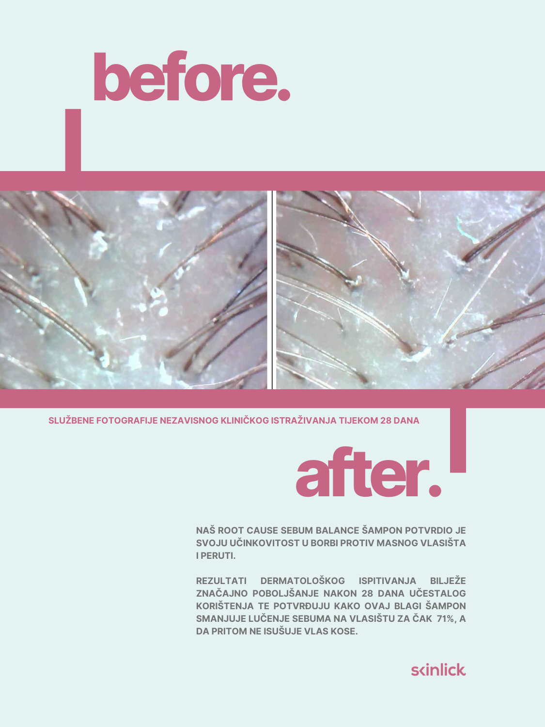 Slika rezultata prije i poslije nezavisnog dermatološkog ispitivanja Skinlick Root Cause Sebum Balance Shampoo blagog šampona